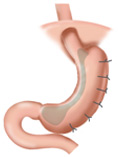 腹腔镜胃大弯摺叠手术