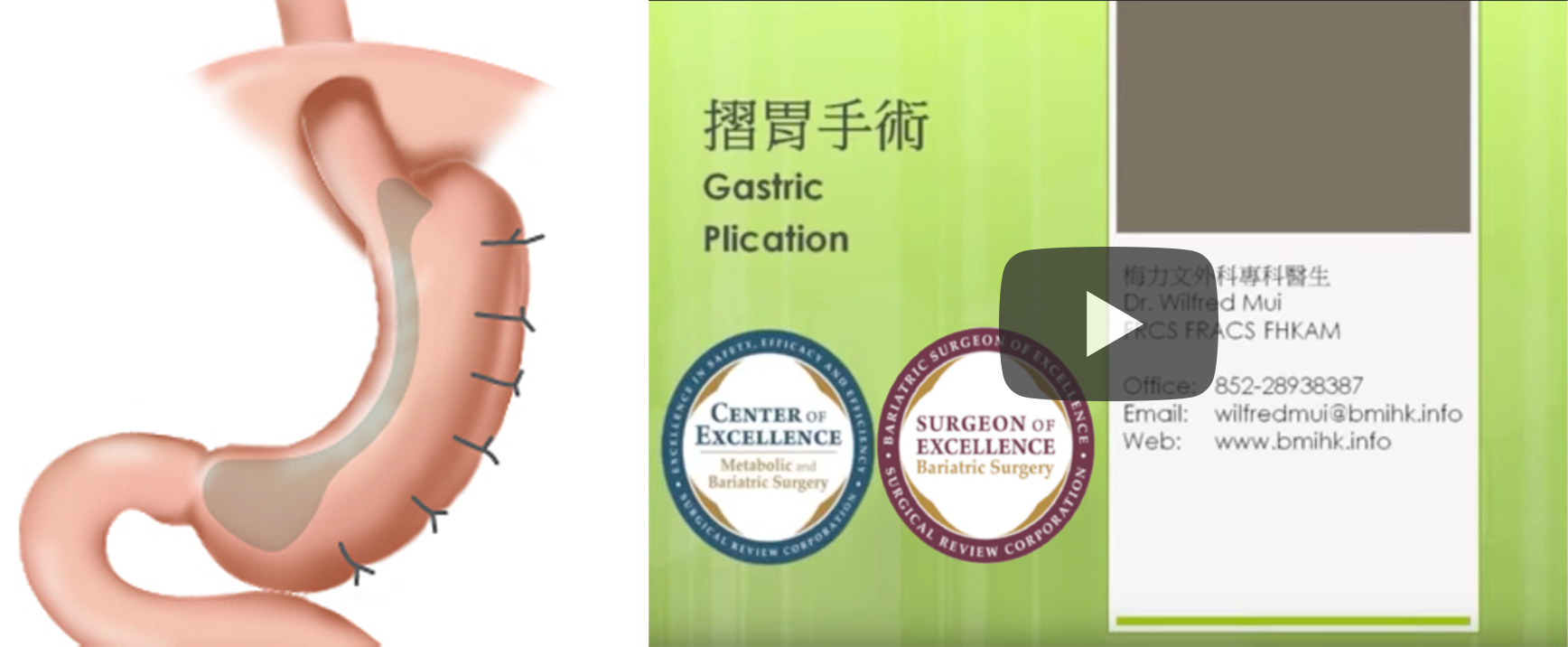摺胃手术 Gastric Plication