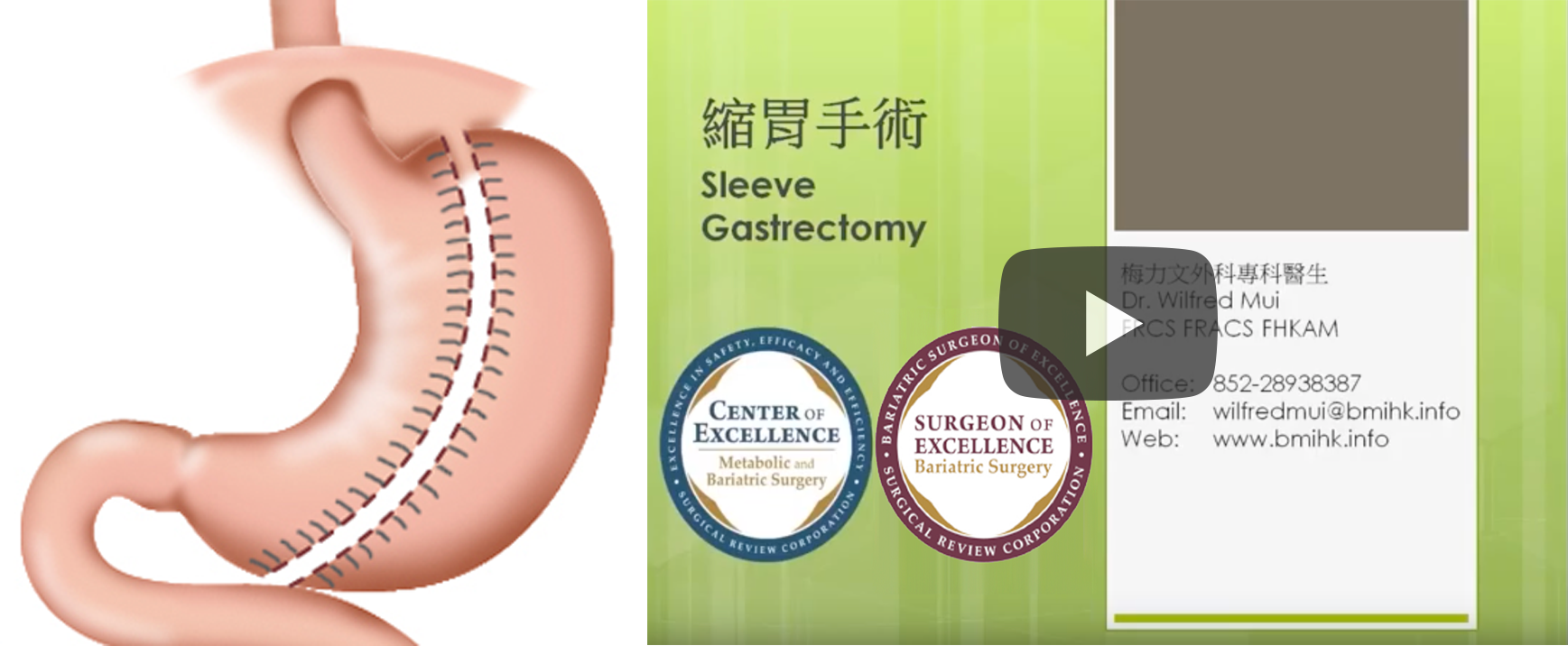 缩胃手术 Sleeve Gastrectomy