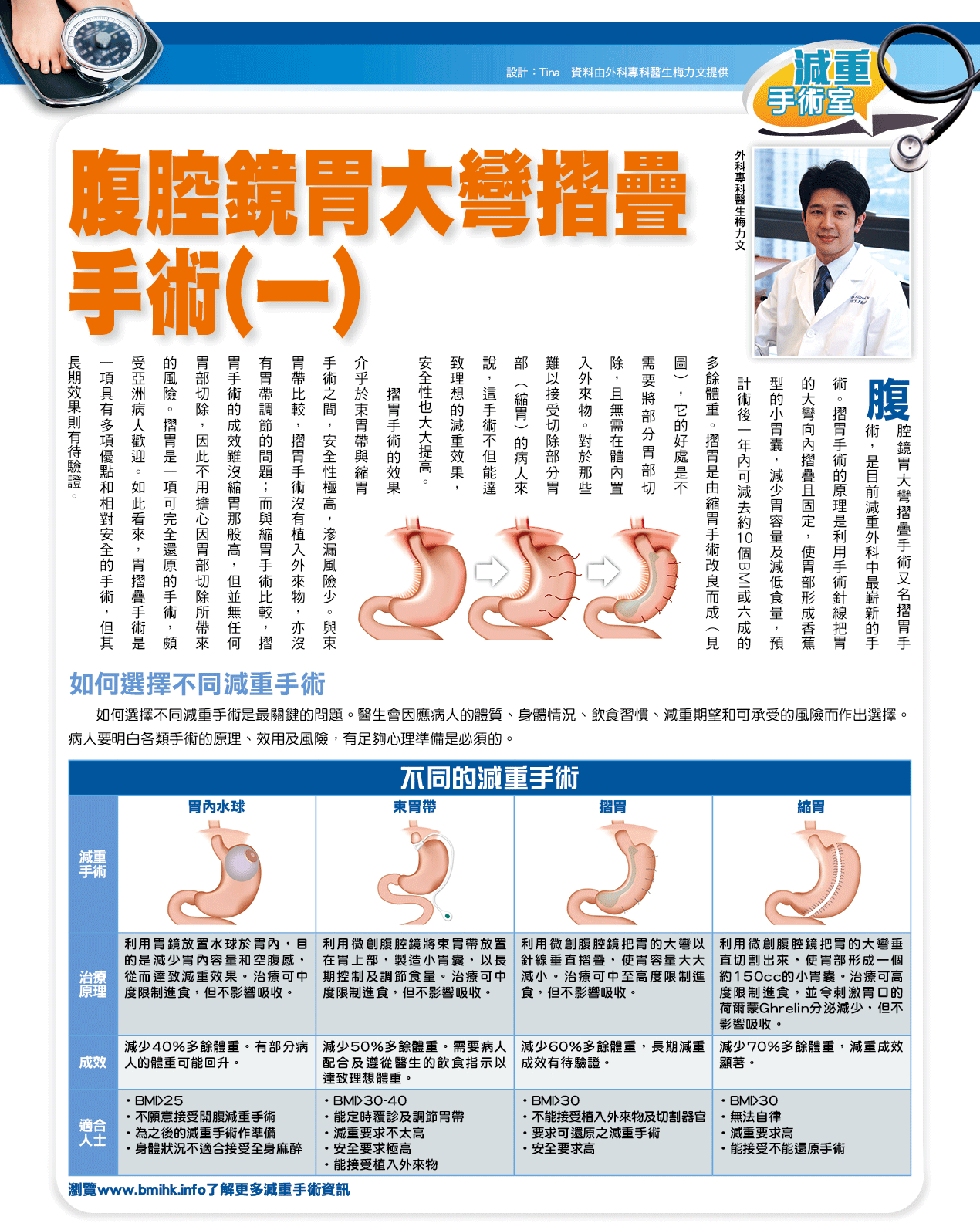 腹腔鏡胃大彎摺疊手術（一