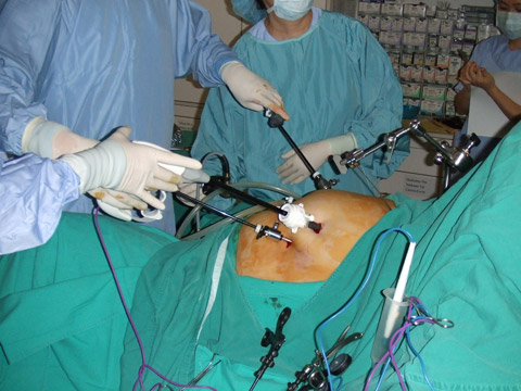 縮胃繞道手術 : 利用微創進行手術，住院約要5-7天