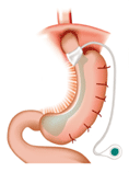 腹腔鏡胃帶摺疊手術