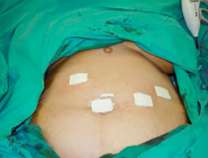 縮胃繞道手術也可利用微創方法進行
